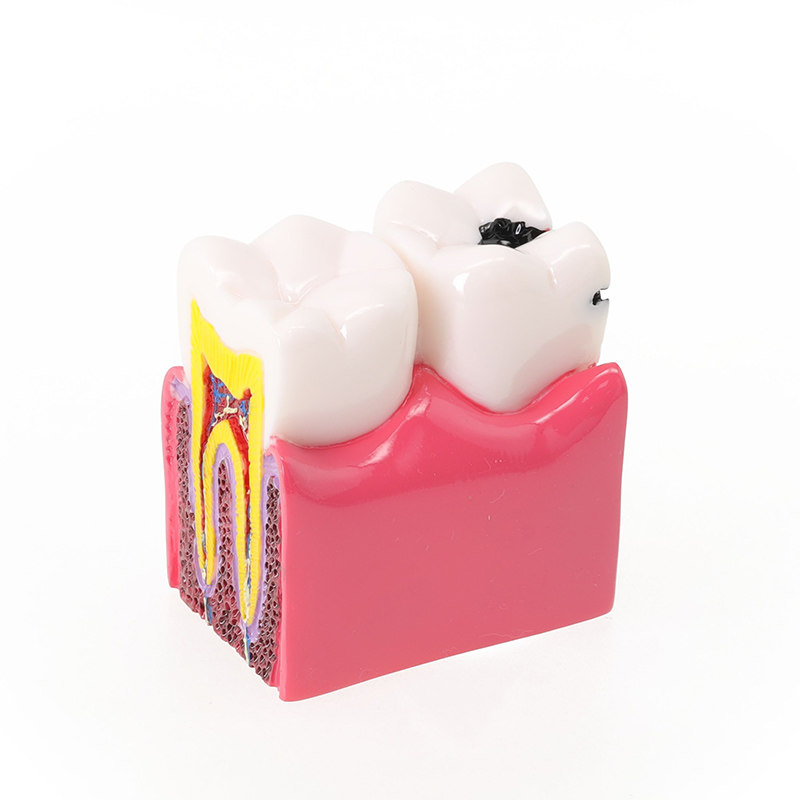 牙齿模型6倍龋齿对比模型 蛀牙演示剖面模型牙科医患沟通教学摆件