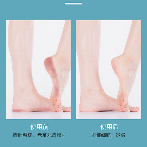 脚底皮干裂价格 脚底皮干裂图片 星期三 脚底皮干裂价格 脚底皮干裂图片 星期三