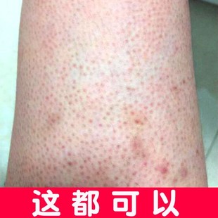 去鸡皮肤疙瘩毛囊角质毛周角化果酸手臂大小腿红点黑点维a软膏治