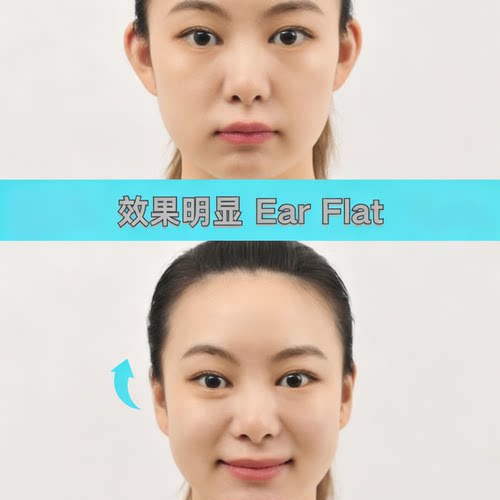 EarFlat成人招风耳高粘矫正贴