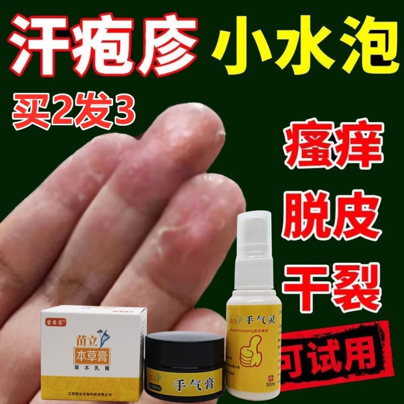 手癣膏真菌感染汗疱疹手脚水泡手指顽固小儿童古偏方