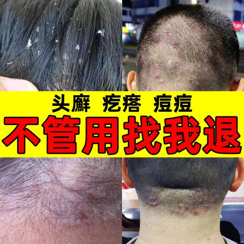 草药喷雾银屑癣外用头皮头上有疙瘩治疗牛皮屑的药鹅掌风真菌感染