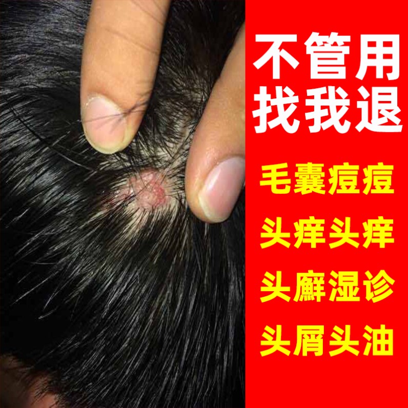 止痒快克断痒拔毒膏头皮癣银屑癣专用药膏真菌克星藏苗肤王软膏云