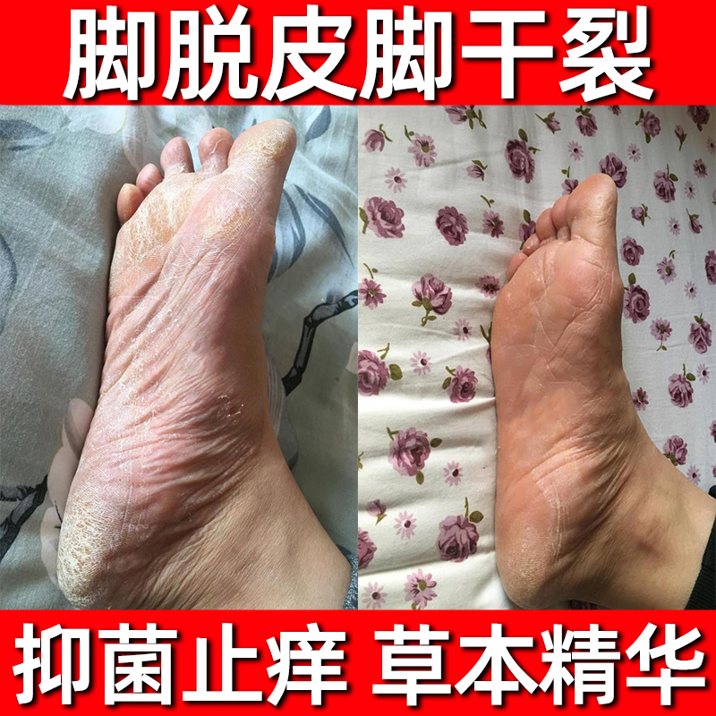 脚气脚癣苗家药膏独家草本药膏脚干裂脱皮真菌感染泡脚手足