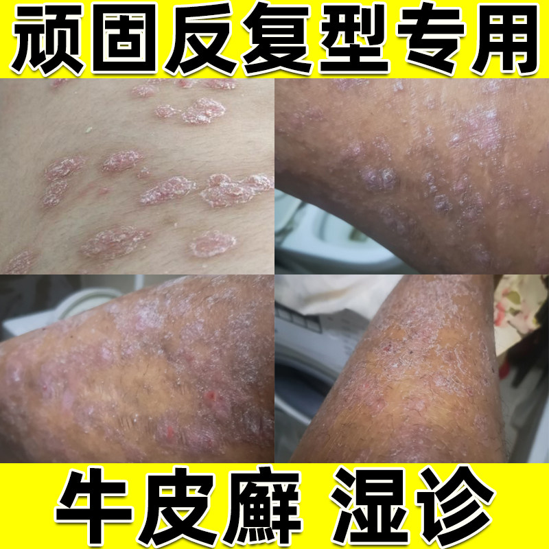 古苗皮藓高仰菌头癣药膏治疗银血病的药擦牛皮癣头皮癣老药师药膏