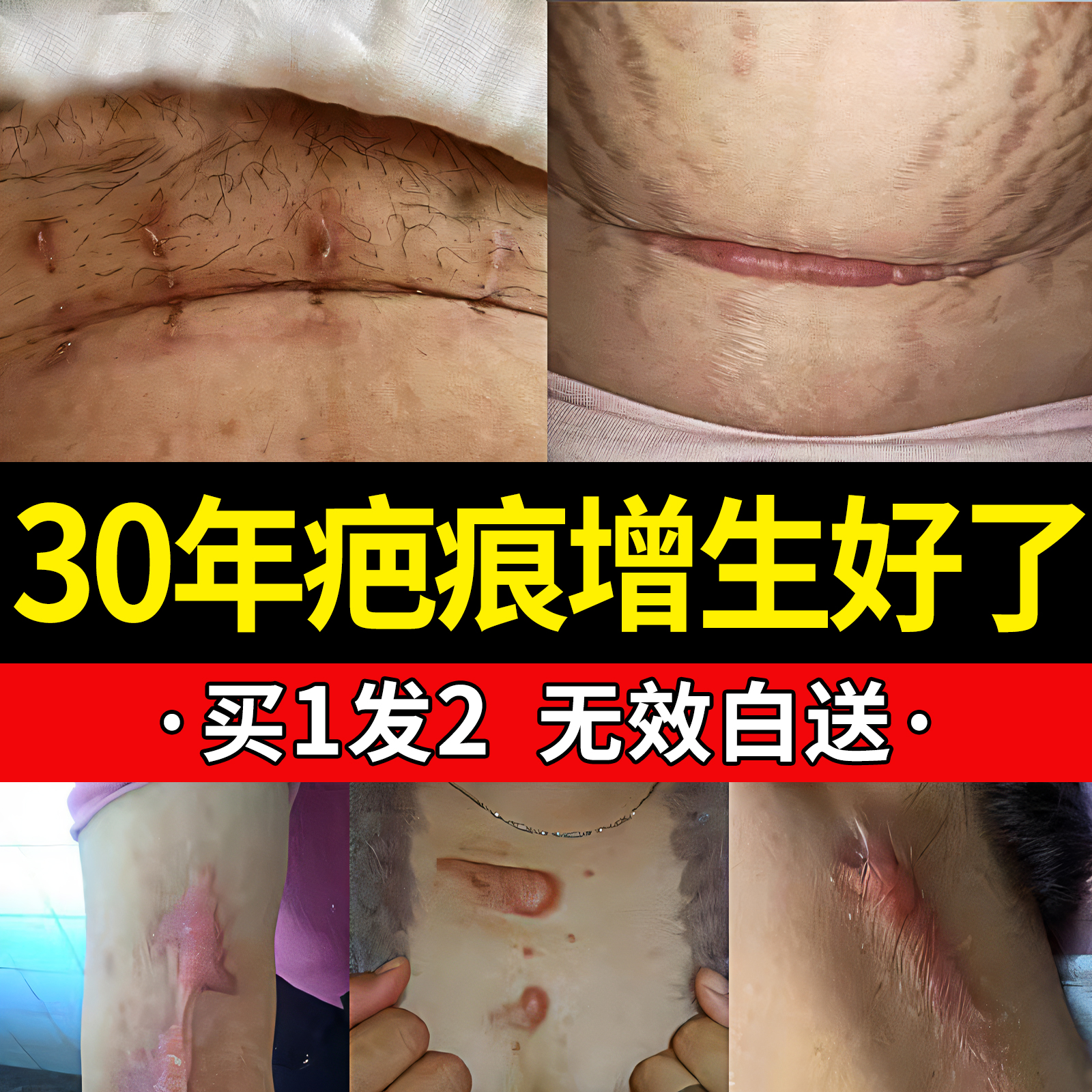 祛疤膏疤痕增生凸起去除疙瘩瘢痕剖腹产修复去疤痕修复凝胶软化针