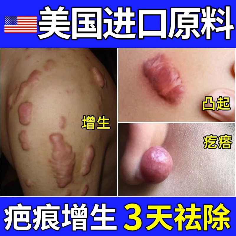 祛疤膏疤痕增生凸起去除疙瘩