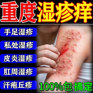 云南真菌王百草膏苗医药止痒特效皮肤瘙痒疹湿拔毒断痒正品抑菌膏