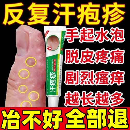 汗泡疱疹药膏【一支见效】