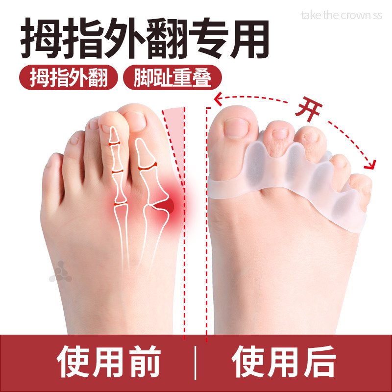 分趾器脚趾专用分离器拇指外翻五指脚趾指甲弯曲大拇指重叠可穿鞋,服饰配件/皮带/帽子/围巾,前掌垫,淘宝优惠券,粉丝福利购,淘宝优惠卷