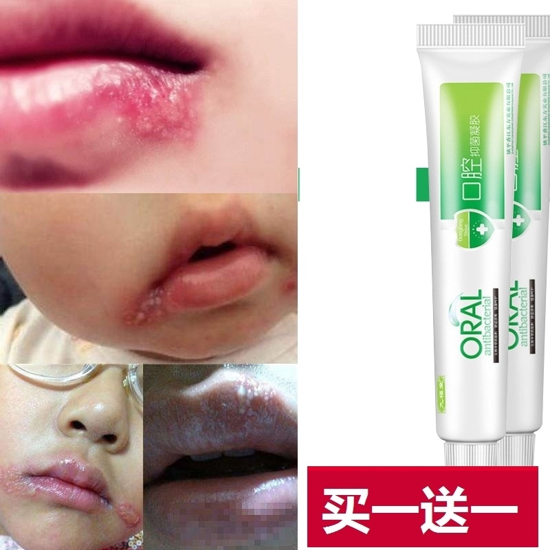 嘴唇疮嘴上火起水泡嘴角起泡黏水疮羊胡疮口角痒烂