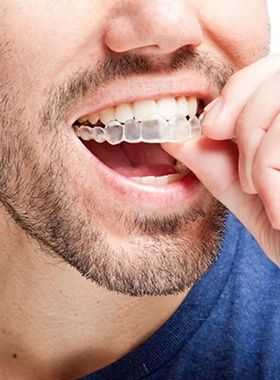 Invisalign-bandejas de termoformado para higiene Dental, ins