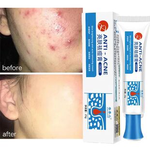 Removal Salicylic Acne Repair Redness Anti Acid Cream