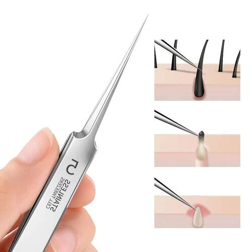 Blackhead Removal Tweezers Stainless Steel Tools - Effective