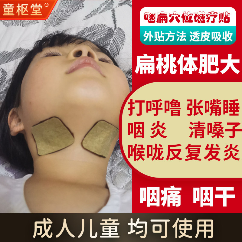 童枢堂咽扁贴扁桃体肥大儿童肿大贴咽喉发炎慢性咽炎贴腺体样张嘴