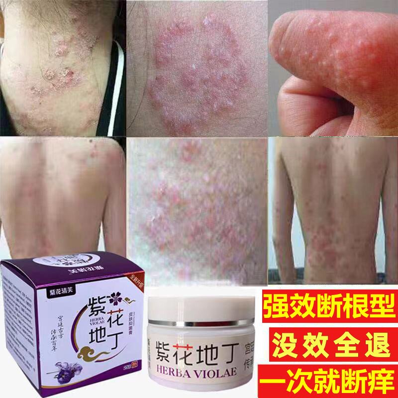 紫花地丁湿毒清软膏祛根湿痒腿皮肤瘙痒湿疹止痒抑菌干燥痒止痒王
