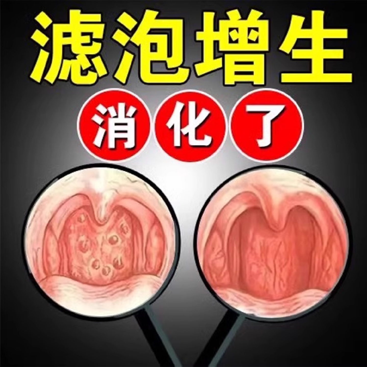 随喷随妤】喉咙滤泡增生咽喉焱淋巴滤泡舌根滤泡干痒咳嗽有异物感