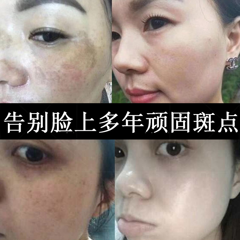 黑斑色斑老年斑祛脸上黄褐斑雀斑面部霜斑点黑色素