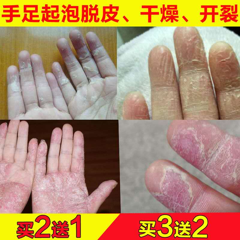 脱皮型干裂反复手部手气脱皮起水泡膏手上手痒止痒小