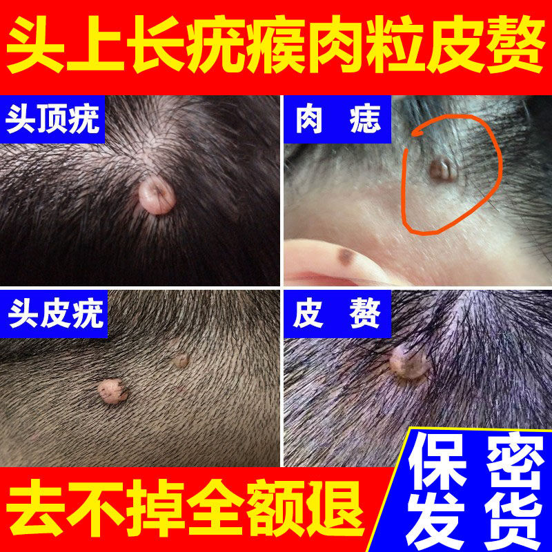 头上长寻常疣肉痣去除膏长猴子肉粒硬疙瘩脸上瘊子皮赘疣祛除正品