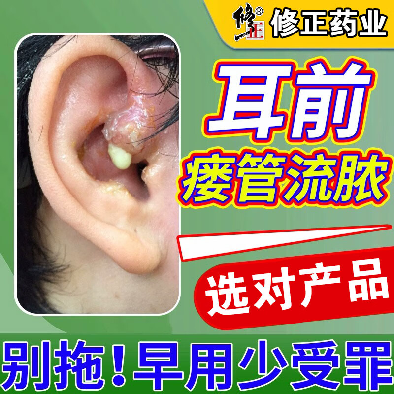 耳瘘流脓膏耳前瘘管发炎耳前小孔感染鼓包红肿专用修复凝胶