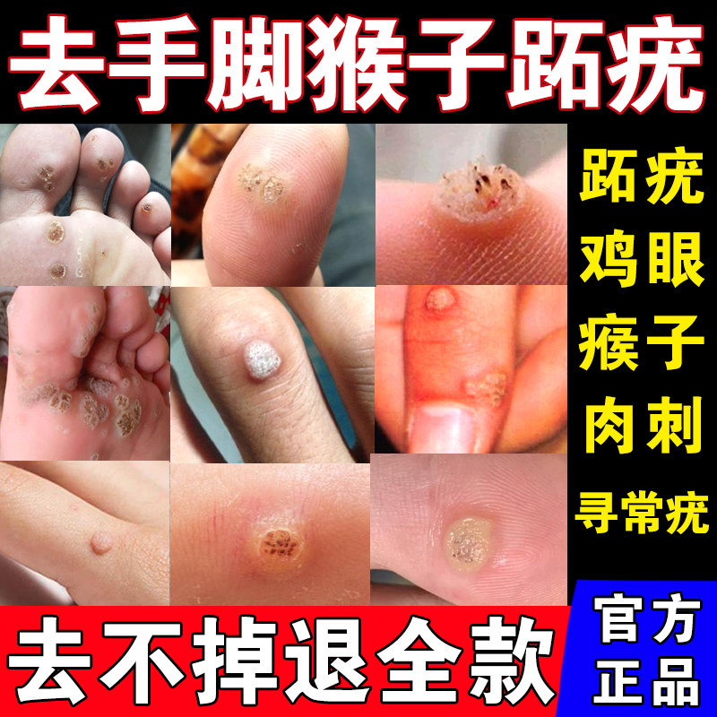 跖疣膏去猴子肉粒疙瘩手脚上长鸡眼医用寻常疣专用肉刺去除膏正品
