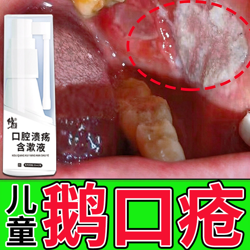 修正鹅口疮婴儿喷雾口腔溃疡专用儿童嘴巴溃烂起泡白斑含漱液