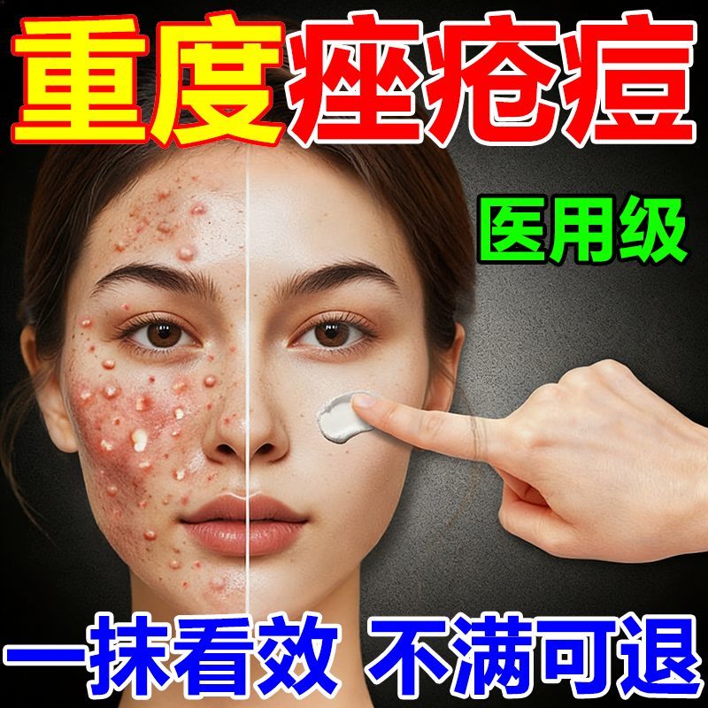 痤疮专用膏玫瑰痤疮粉刺硬消炎青少年保湿补水淡斑学生祛痘印膏药