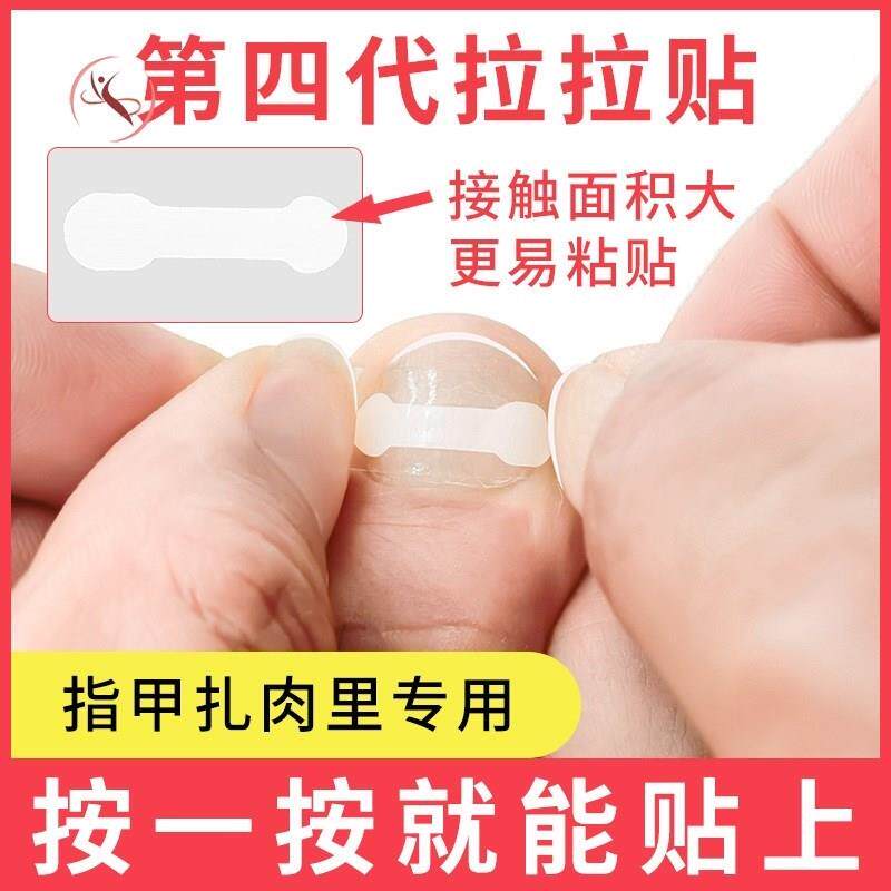 正甲贴甲沟嵌甲沟指甲矫正片脚趾甲指甲长肉里拉拉贴片勾甲炎矫正