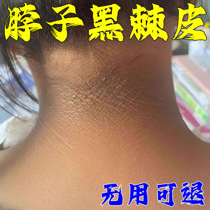 黑棘皮症去除脖子黑色素沉淀淡化黑棘皮洗不干净去黑脖子变白神器