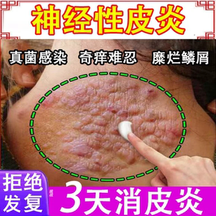 神经性皮炎特根去外用膏治疗除皮肤病癣藓湿疹真菌感染顽固