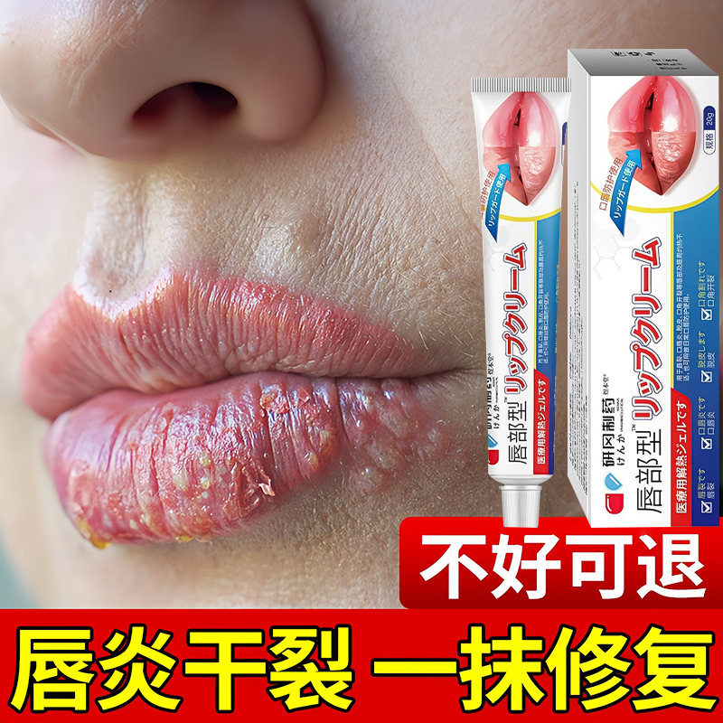 唇炎润唇膏嘴唇干裂脱皮保湿滋润去死皮口角炎医用型修护膏专用