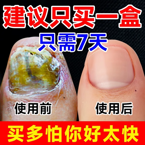 阿莫罗正品芳茶剂趾甲坏甲空甲烂灰指空甲增厚发黄快速修复抑菌