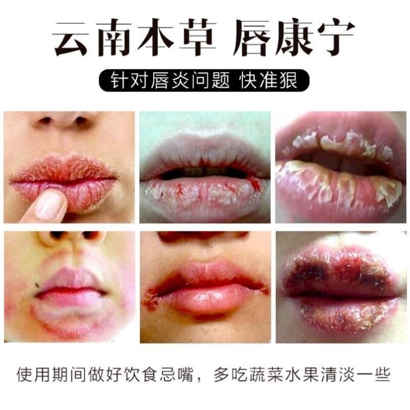 唇康宁唇炎唇膏干裂脱皮起泡烂嘴角红痒植物本草修复