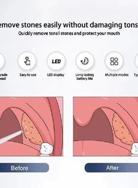 Electric Tonsil Stone Remover Tonsil Stone Removal Kit
