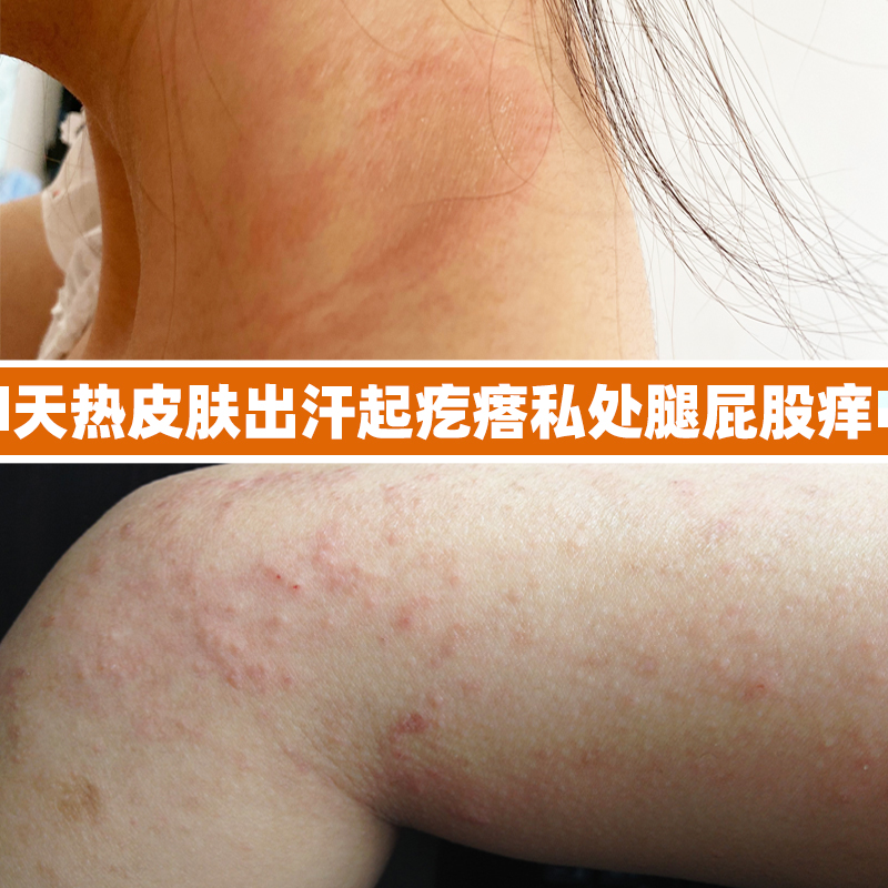天热出汗腿发痒小腿皮肤痒腿上起疙瘩长红点皮肤痒皮肤止痒抑菌膏