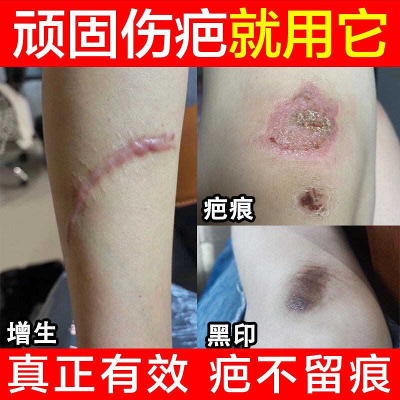 疤痕膏修护疤痕剖腹产增生疤痕手术疤痕刀疤痘印痘坑美容院修复霜