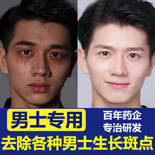 仁和美白祛斑霜祛斑神器男士专用产品雀斑黑斑老年斑去除官方正品