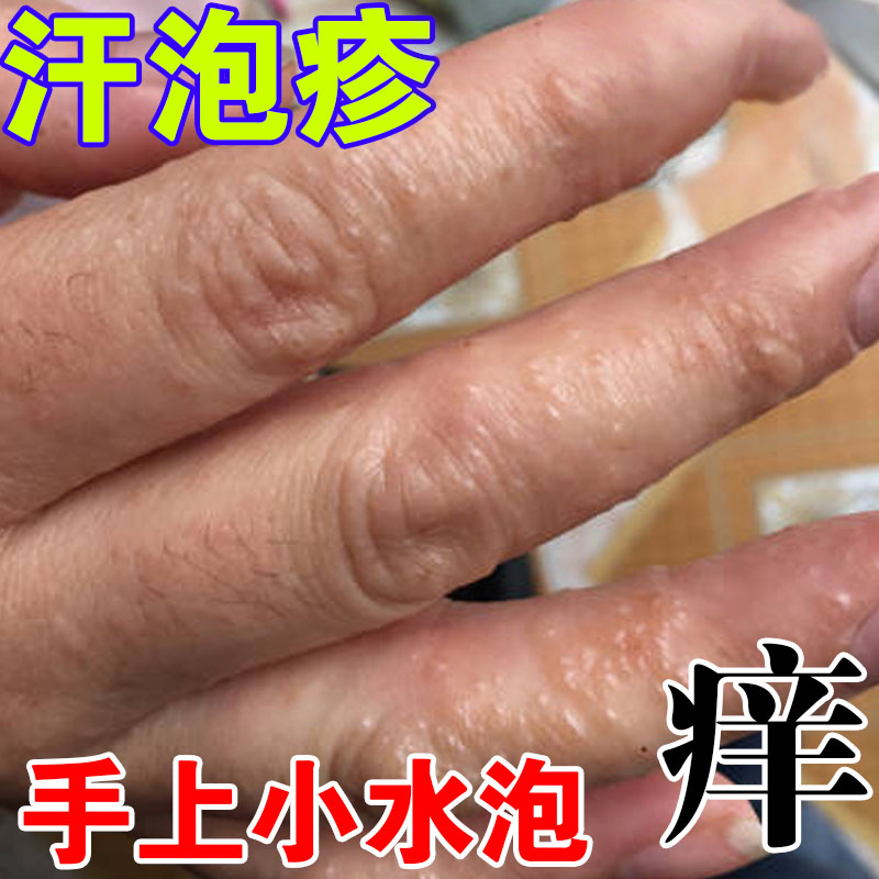 手指起水泡痒药手上长小水泡汗状疹痒疱汉状干裂脱皮膏