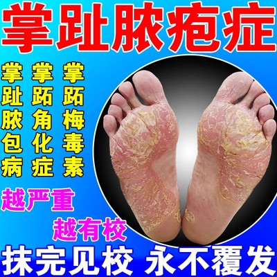 掌趾脓疱病掌跖脓包角化
