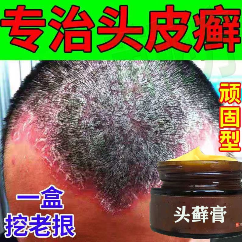 头皮屑头癣的药真菌感染头癣药膏真菌感染脂溢性专t用头痒头屑