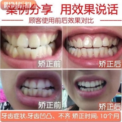 隐形纠正成人款保持器学生缝整爆d牙齿防磨牙包天矫正