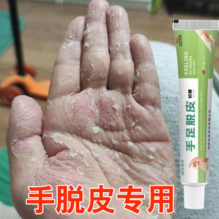 手脱皮药膏严重脱皮专用剥脱性角质松懈症真菌感染蜕皮治手干燥裂