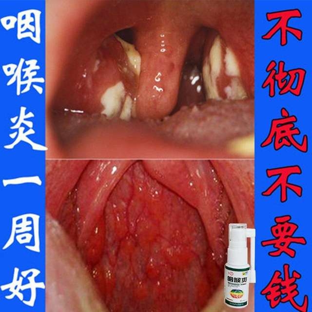 慢性化痰异物感异物感咽炎咽喉爽滤泡性喷剂烟炎喉咙