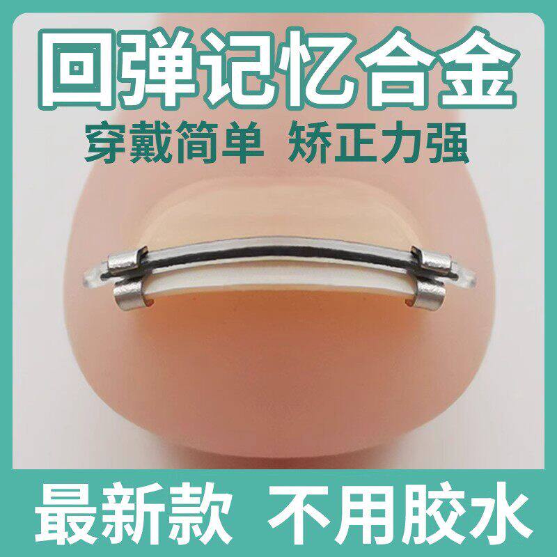 嵌甲矫正器甲沟矫正器纠正神器炎脚趾脚指甲正甲扣专用炎正甲贴