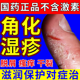 角化型湿疹膏手指干裂脱皮瘙痒手掌粗糙皲裂发黄厚皮炎真菌感染WM