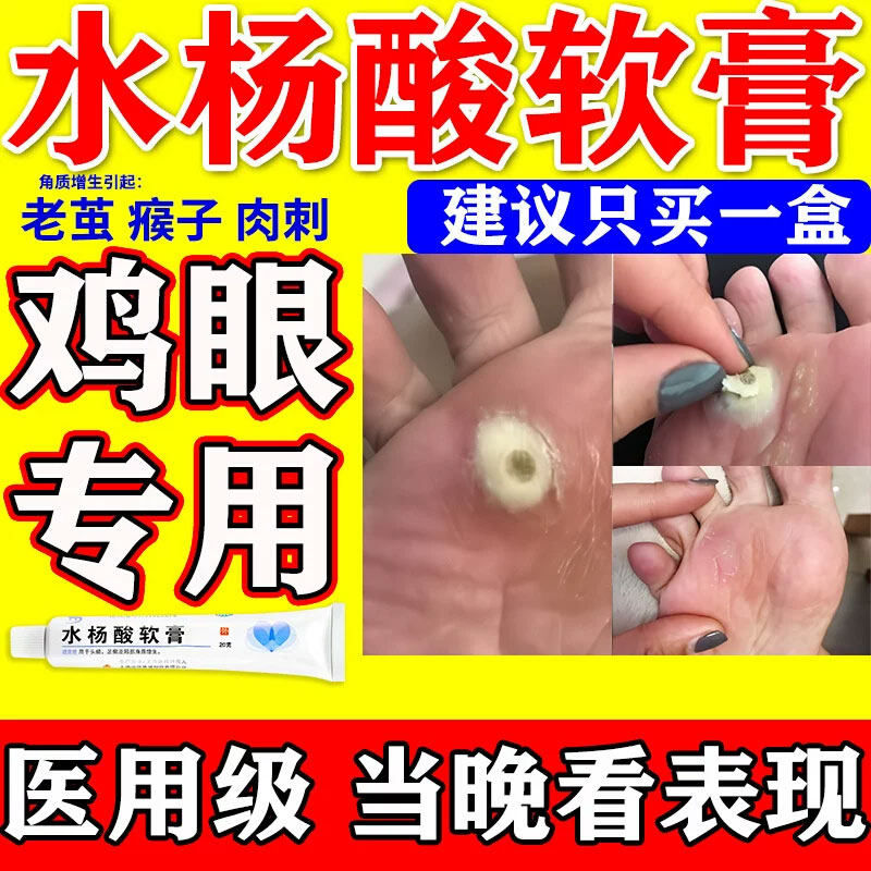 【信龙】水杨酸软膏5%*20g*1支/盒【水杨酸软膏去疣】
