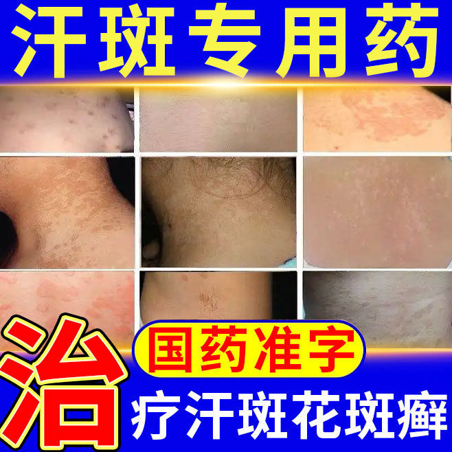 治疗汗斑专用药体癣股癣花斑癣皮肤病专用药膏去手足癣非特效药