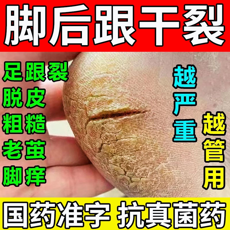 【亮生】环吡酮胺乳膏1%*15g*1支/盒【角化型脚气】