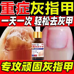 环吡酮擦剂搽剂茶灰指甲治疗专用药脚气甲沟炎治药水正品 旗舰店xl